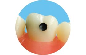 Dente 16.4 - Prodens