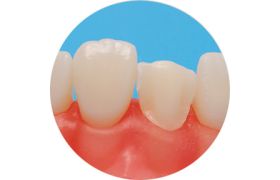 Dente com Preparo DM 11.5 - Preparo de Faceta - Prodens