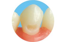 Dente Com Preparo Dm 23.2 - Classe V Na Face Vestibular - Prodens