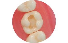 Dente Com Preparo Dm 26.1 - Classe I Na Face Oclusal - Prodens