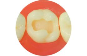 Dente Com Preparo Dm 16.6 - Classe L Na Face Oclusal - Prodens