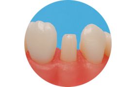 Dente Com Preparo Dm 12.3 - Conoide - Prodens