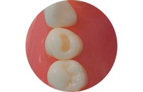 Dente Com Preparo DM 34.1 - Classe I na Face Oclusal sem proteção de Cúspide - Prodens