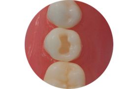 Dente Com Preparo Dm 35.1 - Classe I Na Face Oclusal - Prodens