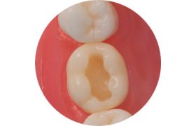 Dente Com Preparo Dm 36.1 - Classe L Na Face Oclusal - Prodens