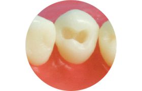 Dente Com Preparo DM 44.2 - Classe L na Face oclusal sem proteção de Cúspide - Prodens