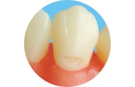 Dente Com Preparo Dm 13.3 - Classe V Na Face Vestibular - Prodens