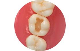 Dente Com Preparo Dm 17.1 - Classe I Na Face Oclusal - Prodens