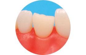 Dente Com Preparo Dm 21.6 - Dente Fraturado - Prodens